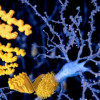 Alzheimer
